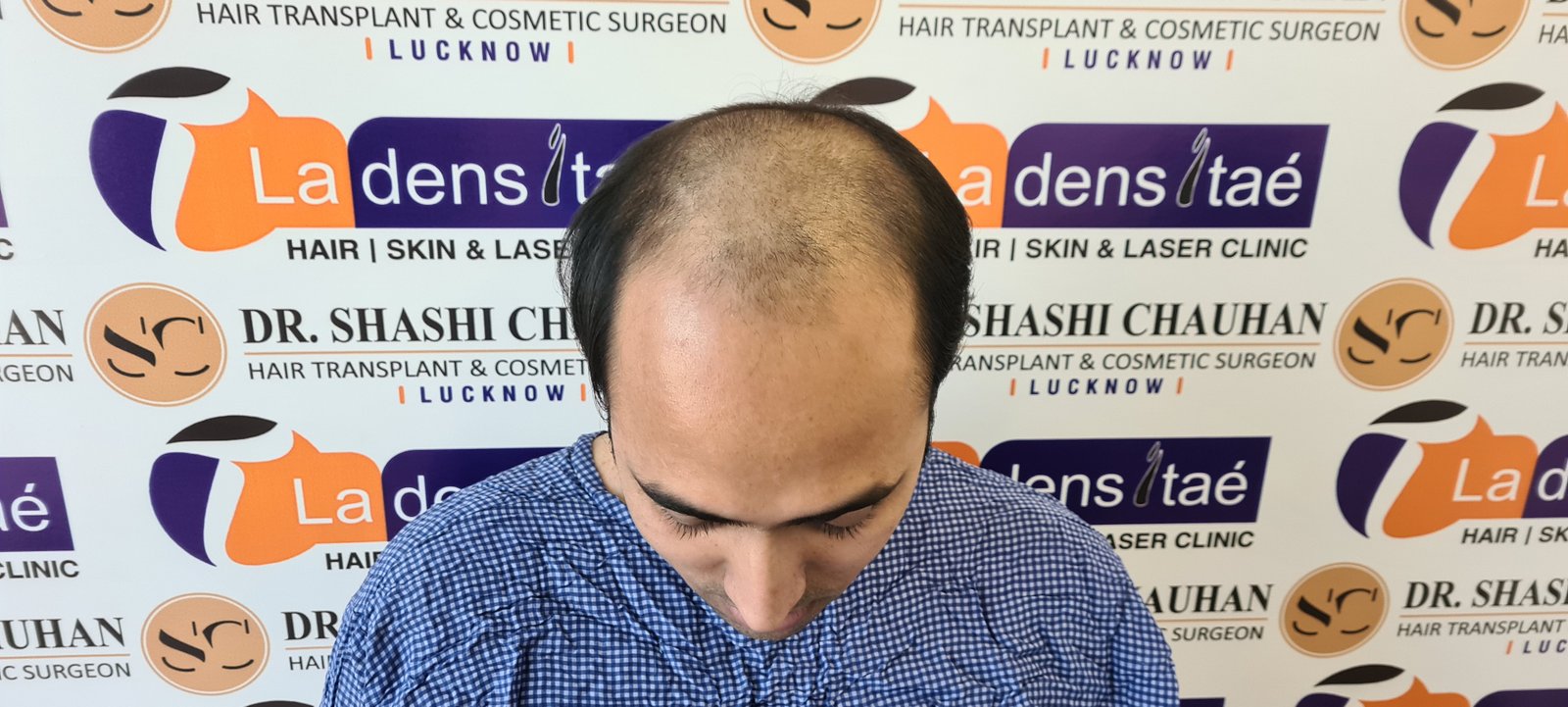 Utsav Aman Before Hair Transplant